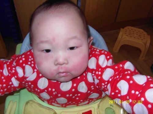 小儿麻疹有什么症状