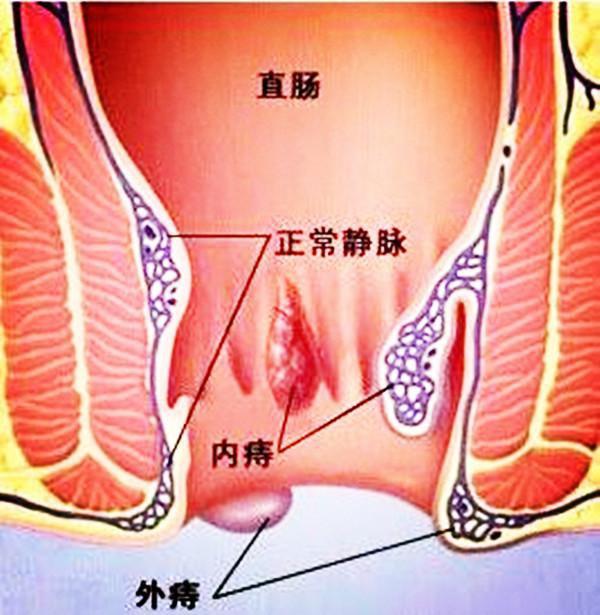 孕期痔疮疼怎么办能用药吗