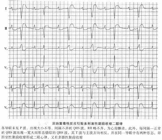 孕妇心律失常怎么办