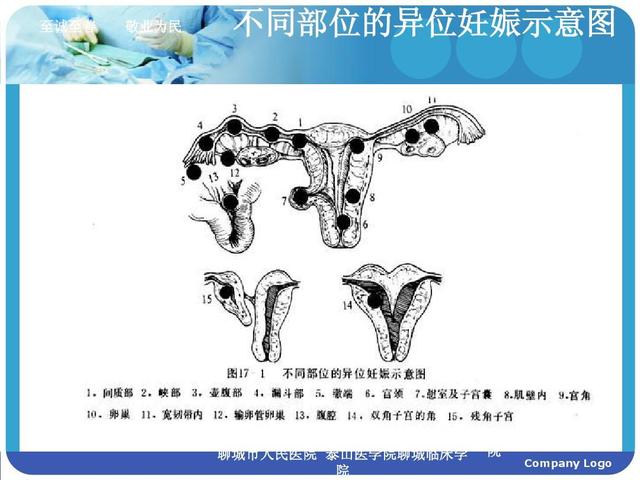 左侧异位妊娠是什么意思