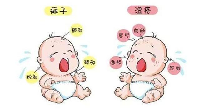 孩子湿疹和痱子有什么区别