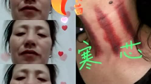 老铁们晚上好，专业揪痧