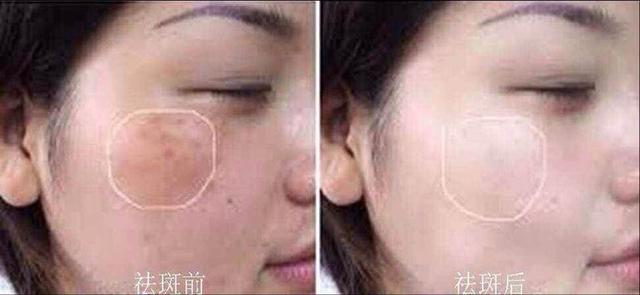 马油真的可以消除妊娠纹吗