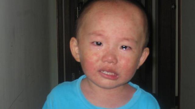 幼儿急疹了怎么办