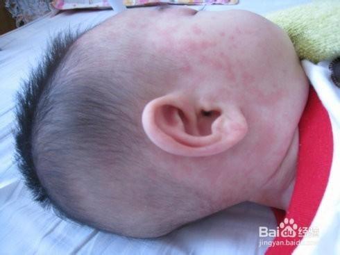 幼儿急疹的症状有哪些