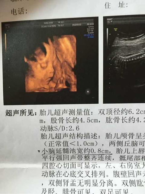 怀孕多久可以做排畸检查