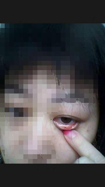 新生儿眼皮上有红斑会消失吗