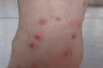 【二次感染有什么症状
 ,梅毒二次感染有什么症状】