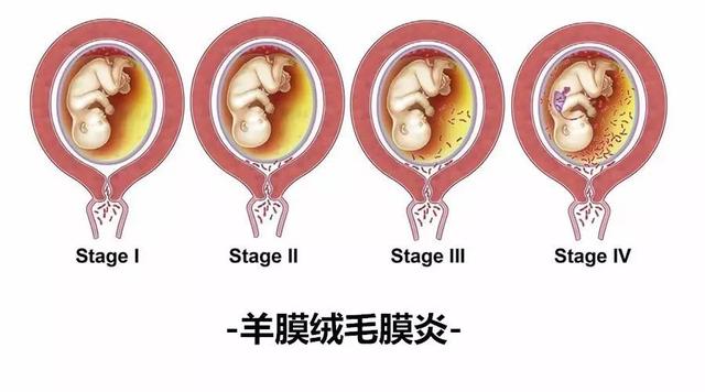 羊膜腔感染如何治疗