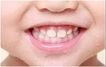 孩子牙齿反颌是什么造成的牙齿反颌是什么原因造成的