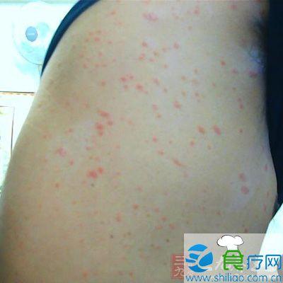 春季怎么预防皮肤病