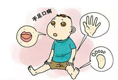 手足口病高发期孩子应该怎么预防