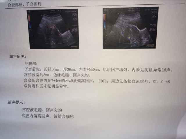 b超监测排卵怎么做
