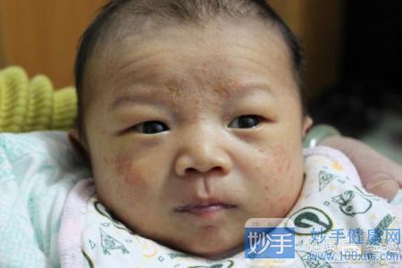 新生儿痤疮和新生儿湿疹区别