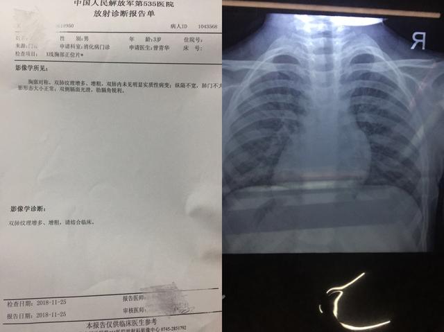 4岁孩子咳嗽有痰咳不出来怎么办