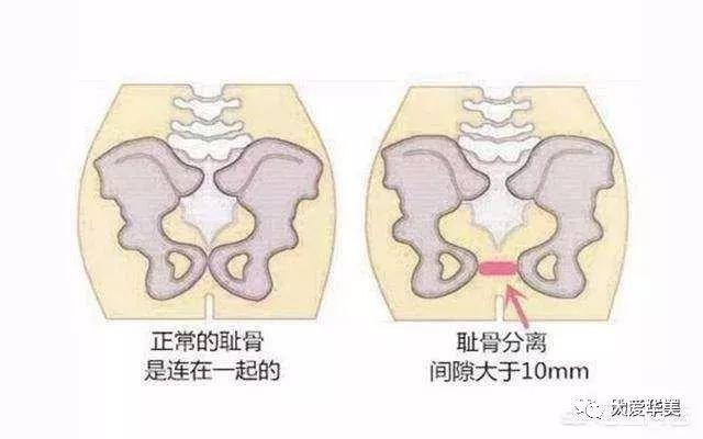 孕妇耻骨痛是哪个部位图片