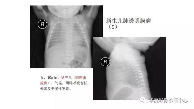新生儿常见的几种疾病