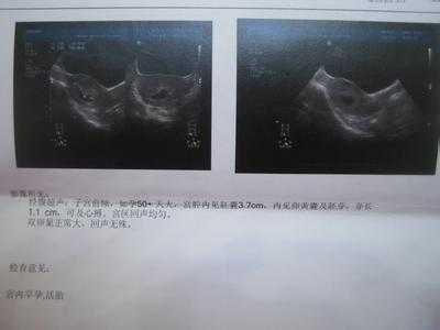 如果是空孕囊有什么症状