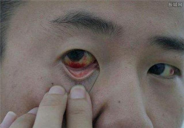 睫毛上有螨虫怎么回事