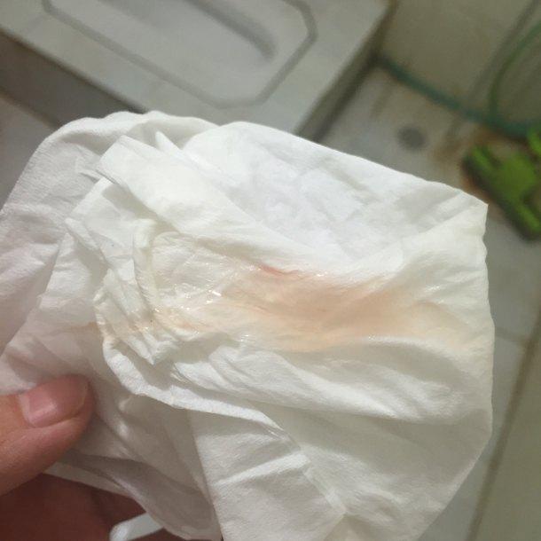 怀孕了分泌物有点血丝
