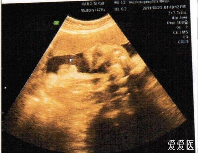 怀孕17周胎儿发育情况是怎么样的?