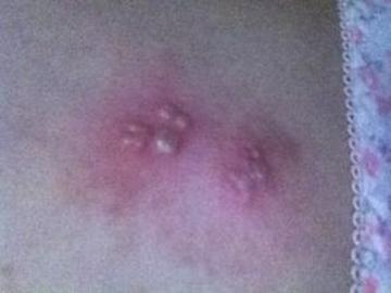 【二次感染有什么症状
 ,梅毒二次感染有什么症状】