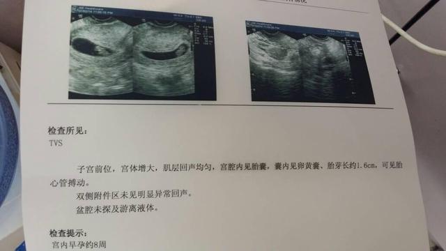 怀孕囊的形状看男女