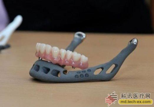 3d打印牙齿-3d打印如何改变整牙生意