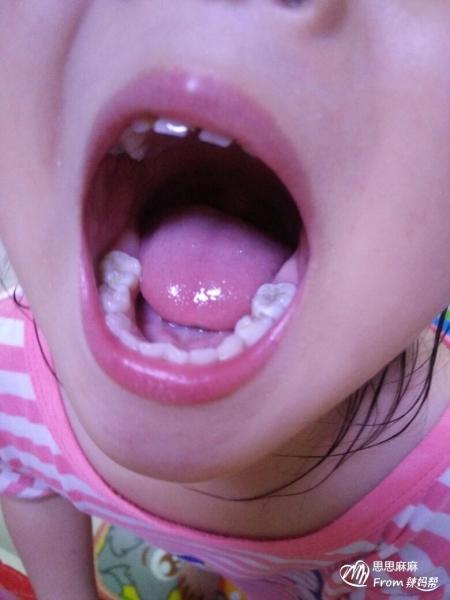 宝宝没有龋齿用涂氟嘛