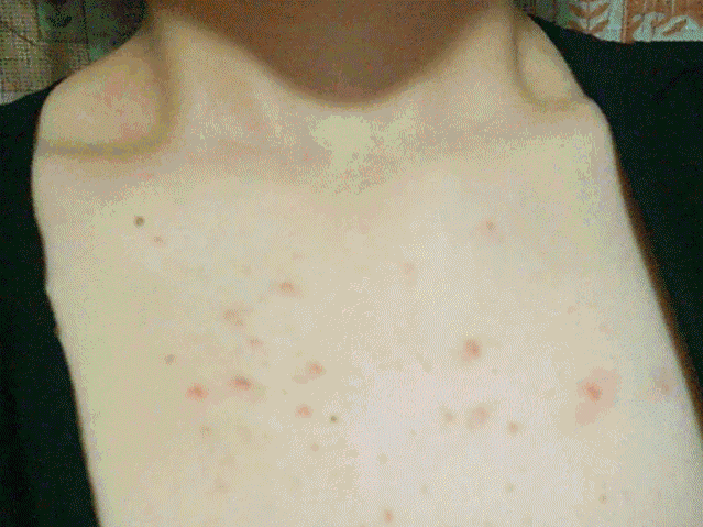 后背长痘是螨虫吗?