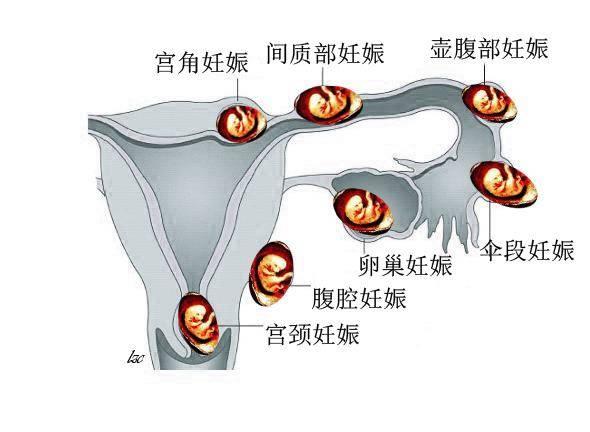 宫外孕怎么预防