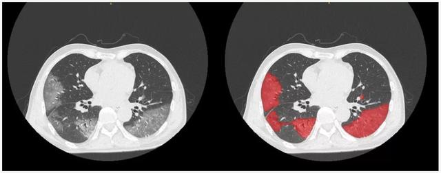 ct作为新型肺炎确诊标准