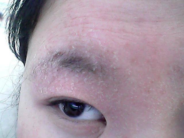 夏季如何预防宝宝皮肤问题