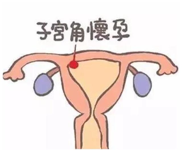 孕囊和胚胎的区别图