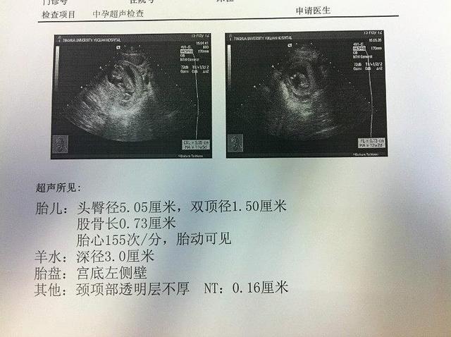 胎儿室间隔2mm还能要吗?