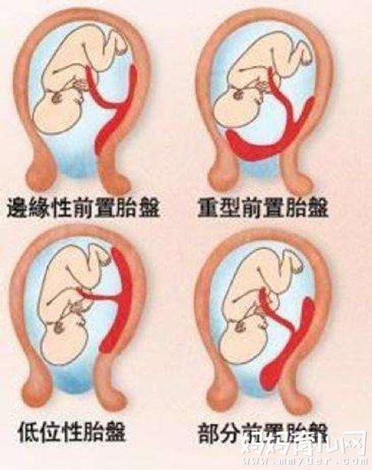 胎盘植入切除子宫概率