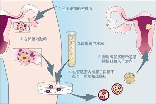 子宫后位如何快速怀孕提高受孕率