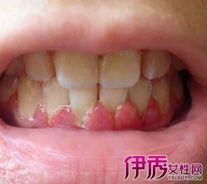 九成以上成年人有牙周疾病