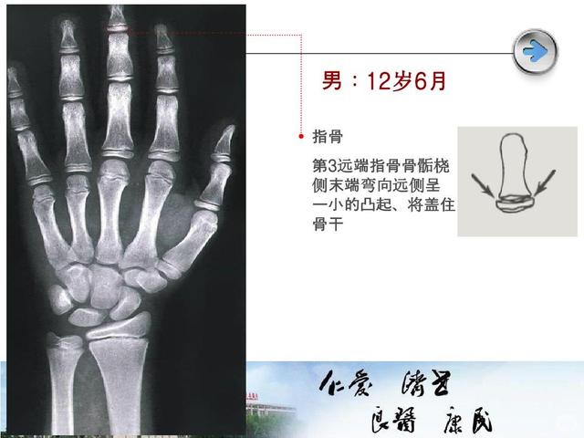 8岁女孩骨龄达11岁，医生称未来身高不超1.5米，只因用了它