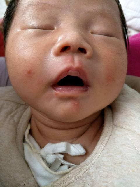 孩子有湿疹吃什么食物