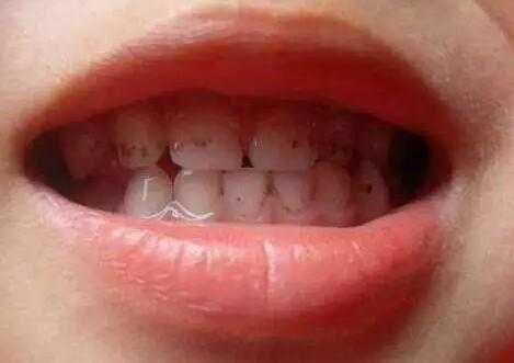 孩子牙齿上的黑斑是什么