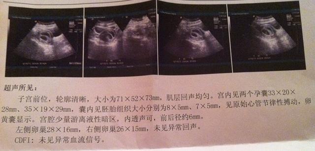 试管婴儿养囊胚是什么意思