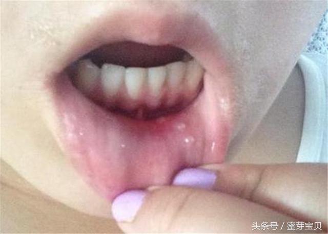 孩子口腔溃疡该怎么办