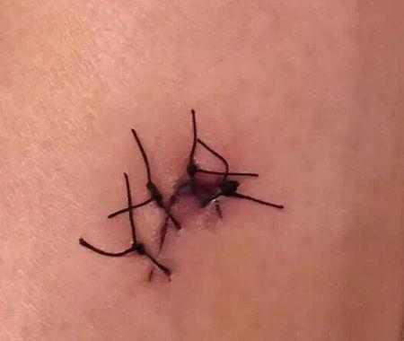 顺产撕裂伤口怎么护理恢复快