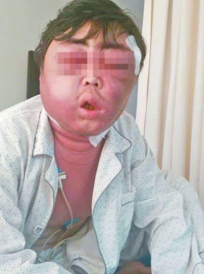 太悲催!夏夜加班被蚊子咬脸肿成球医院下病危通知