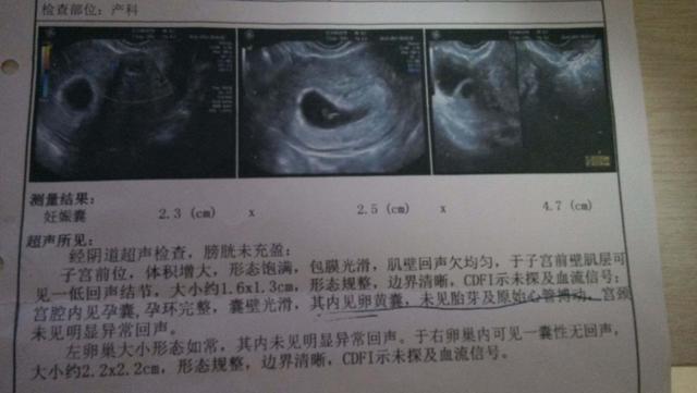 孕囊和卵黄囊的区别图片