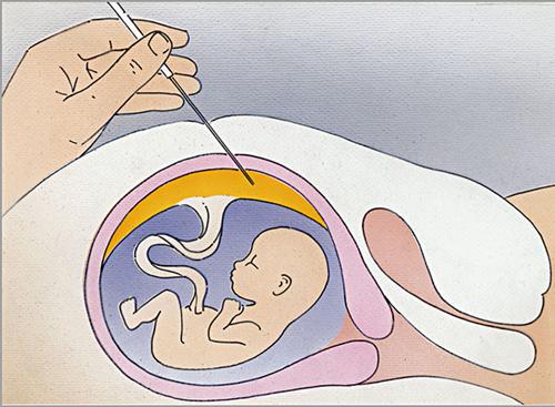 这5类孕妇，必须做羊水穿刺检查，否则胎儿危险