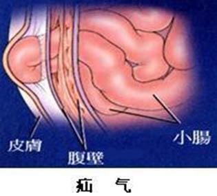 小儿疝气怎么治疗最好