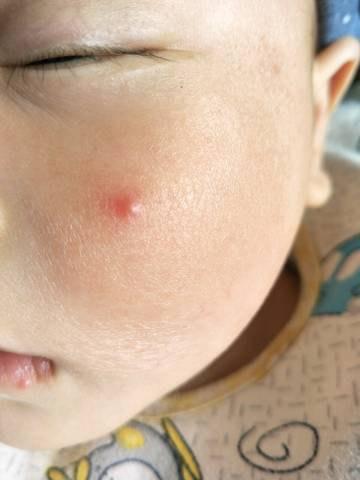 一岁半宝宝脸上长痘痘是怎么回事