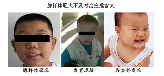 孩子腺样体肥大是怎么回事